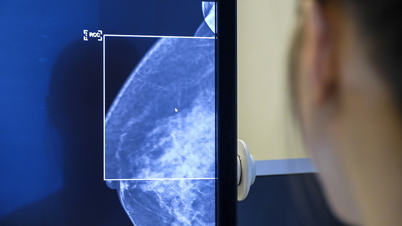 Röntgenbild av bröst på skärm från mammografiscreeing