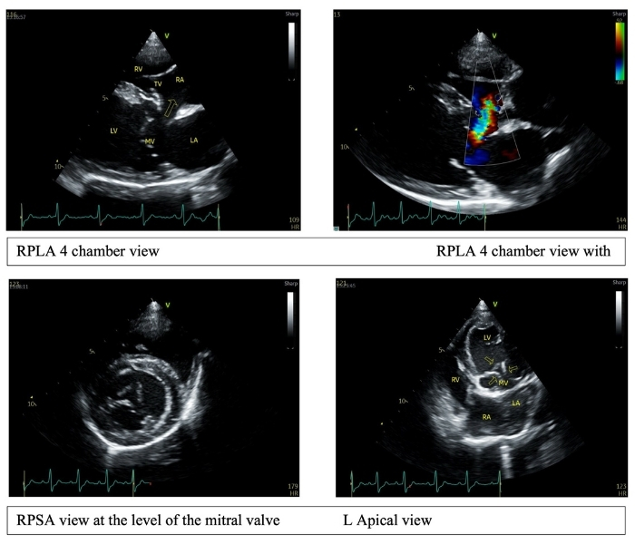 Echocardiography showing four heart chambers