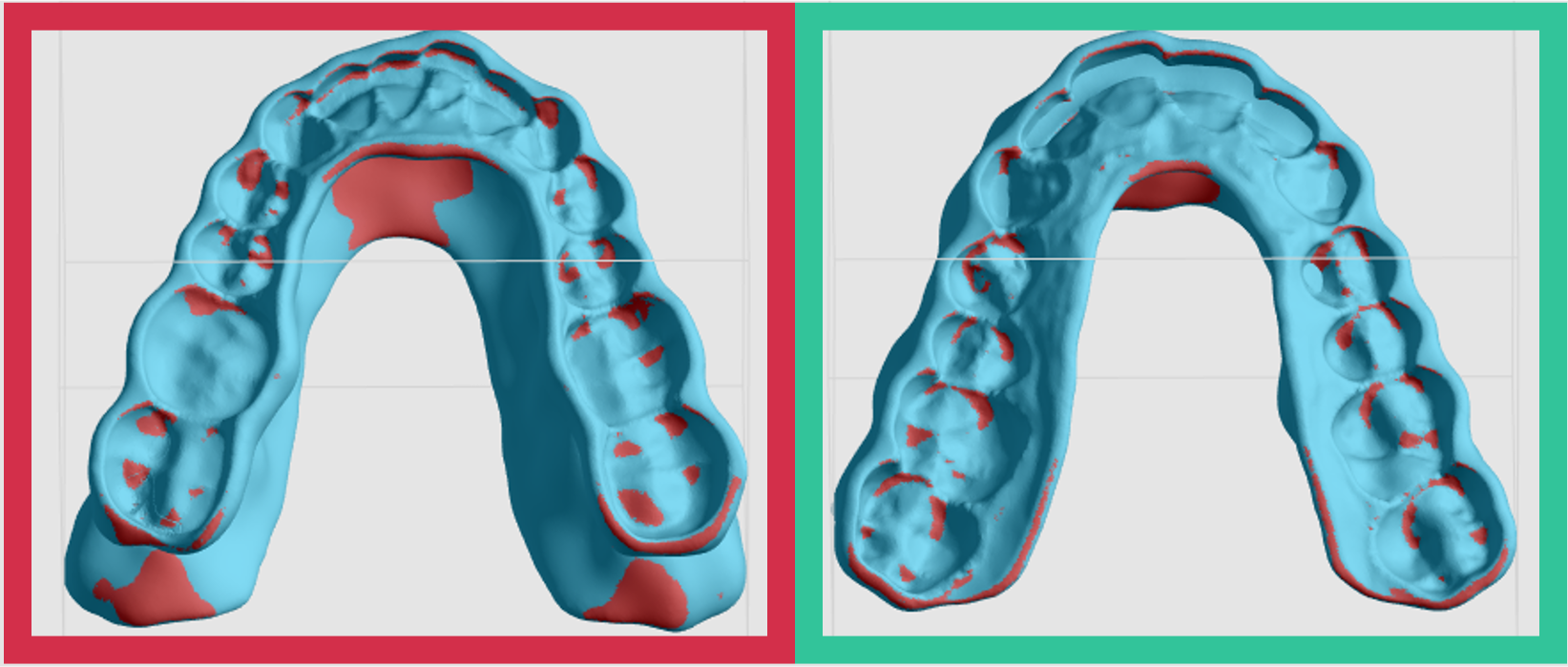 The maxillary side of the splint has fewer overhangs and should be the side that is supported. The maxillary side of the splint has fewer overhangs and should be the side that is supported.
