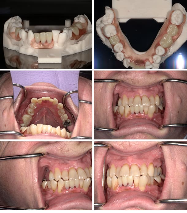6 images of client mouth open showing denture work