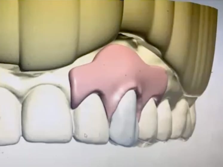 Digital model of teeth