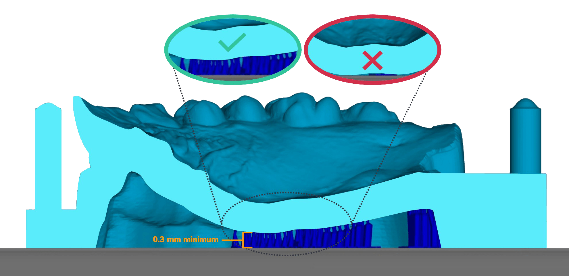0.3 mm minimum height below palate 0.3 mm minimum height below palate