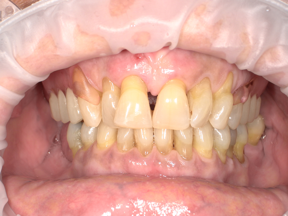Closing the Digital Gap: How Carbon & Keystone Industries’ FP3D Brought Precision, Predictability and Patient Satisfaction to Removable Partial Dentures