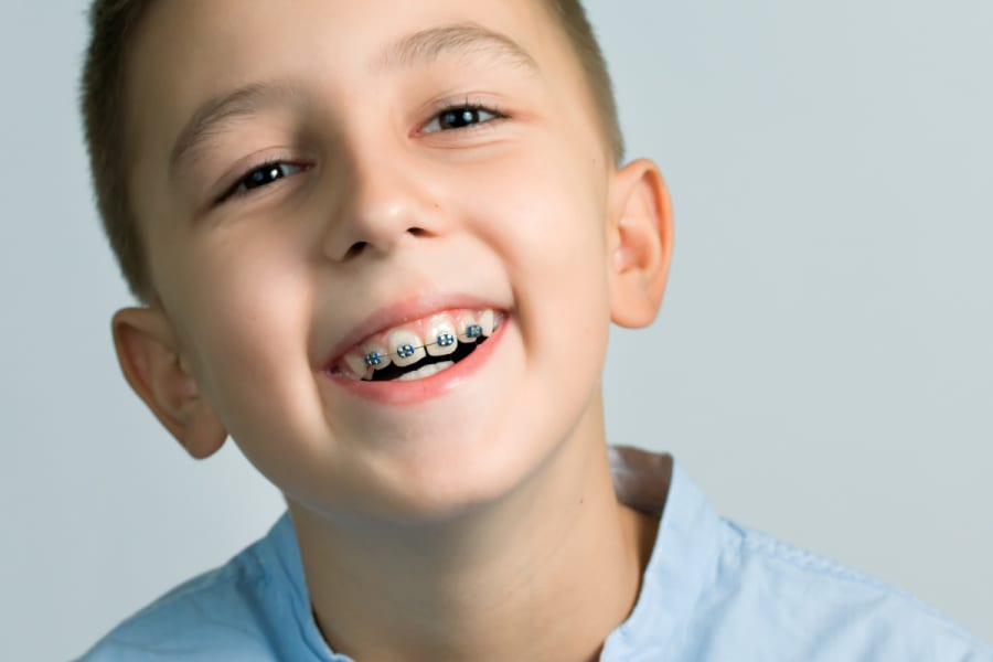 Vergoedingen orthodontie