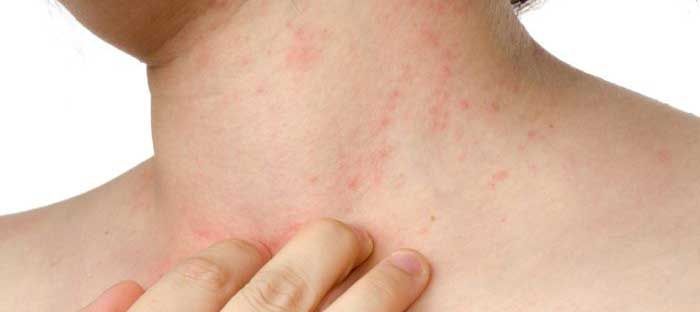 Psoriasis - Gejala, penyebab dan mengobati Psoriasis - Gejala, penyebab dan mengobati