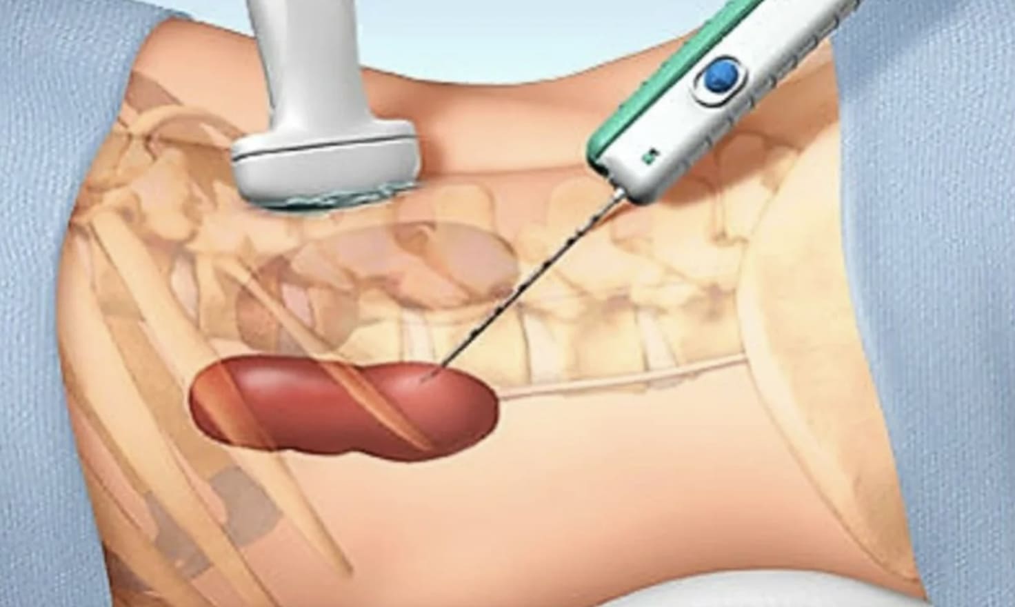 Kidney biopsy image