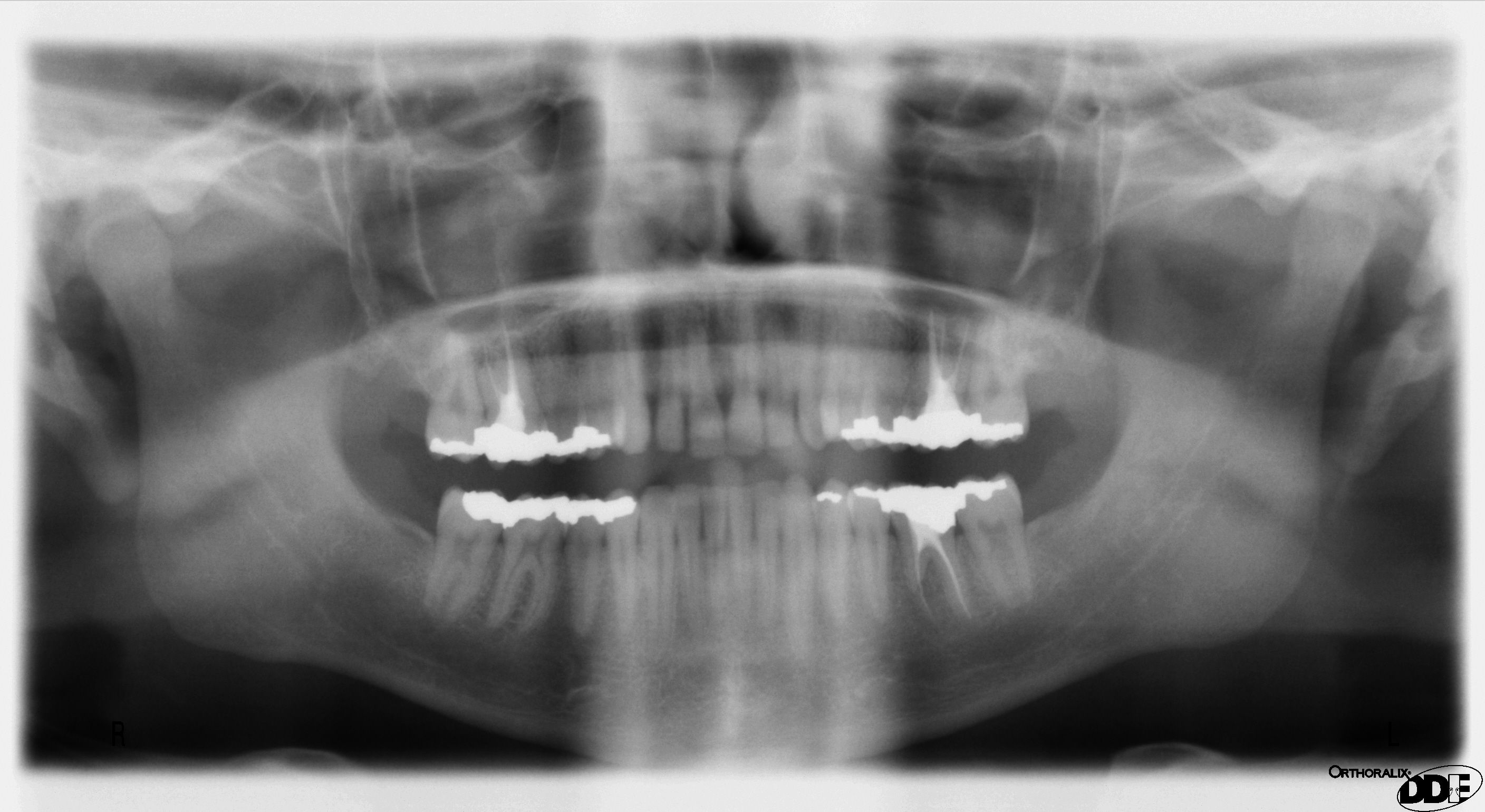 Panoramic Dental X-Ray