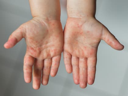 Как проявляется атопический дерматит и как его лечат?