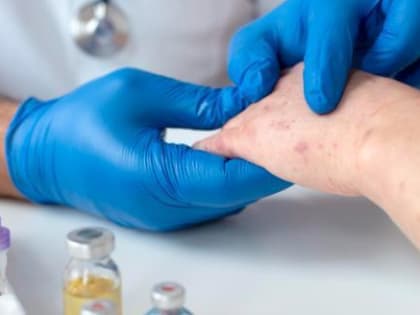 Вологжанам рассказали, как не подхватить корь, путешествуя по стране