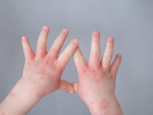 Симптомы и лечение распространенных кожных заболеваний у детей