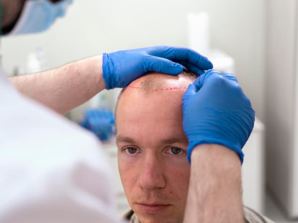 Трансплантация волос: сравниваем подходы и методы