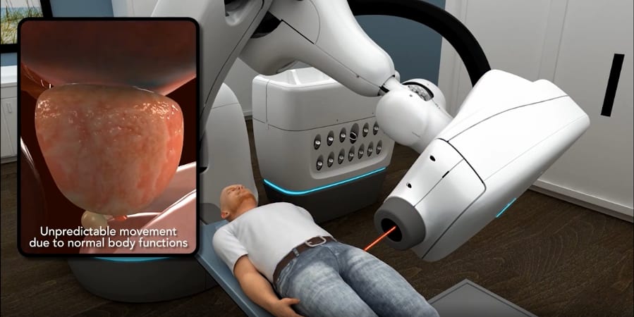 CyberKnife Video Prostata Vorschaubild