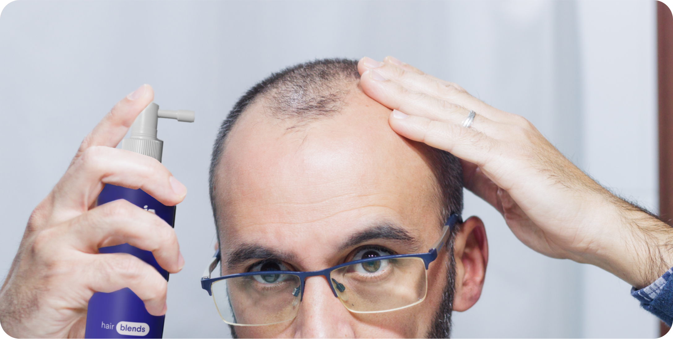 Dutasterida 0.25% + Minoxidil 7% + Tretinoína 0.0125%