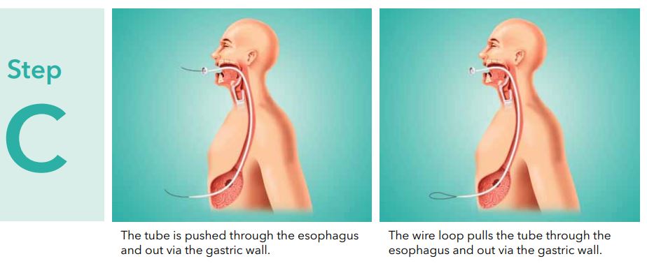 Assisted Feeding: When to Consider a Feeding Tube – Clinical