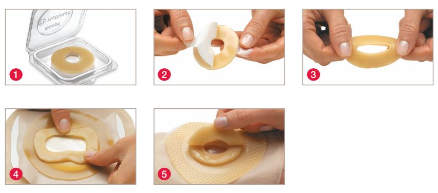 7805 Hollister Adapt Ostomy Barrier Rings  Hollister Ostomy Accessories  from Parthenon