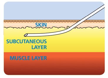 BD_Subcutaneous_Infusion_Therapy