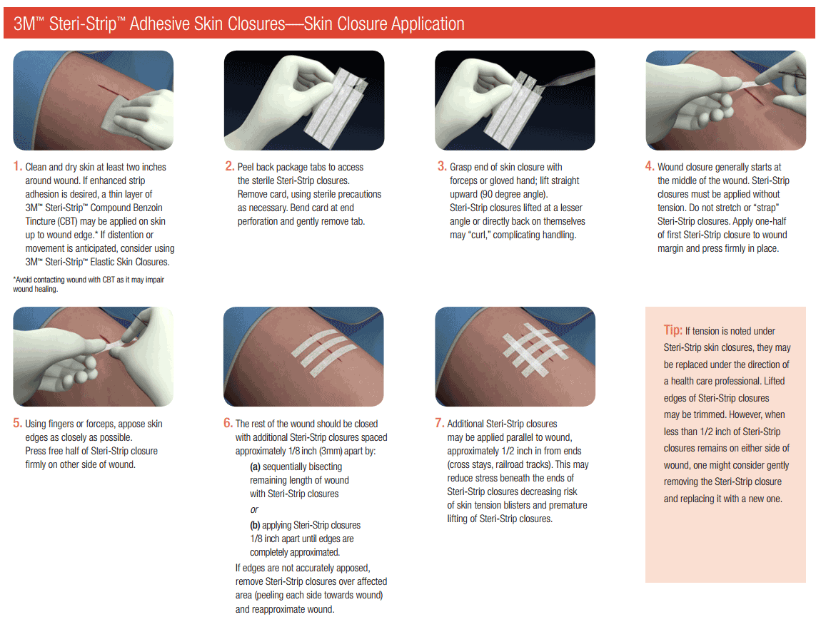 Steri Strip Technique At William Avila Blog Steri Strip Technique At William Avila Blog
