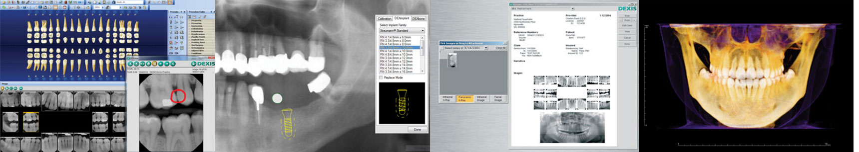 dexis platinum vs dexis titanium sensor