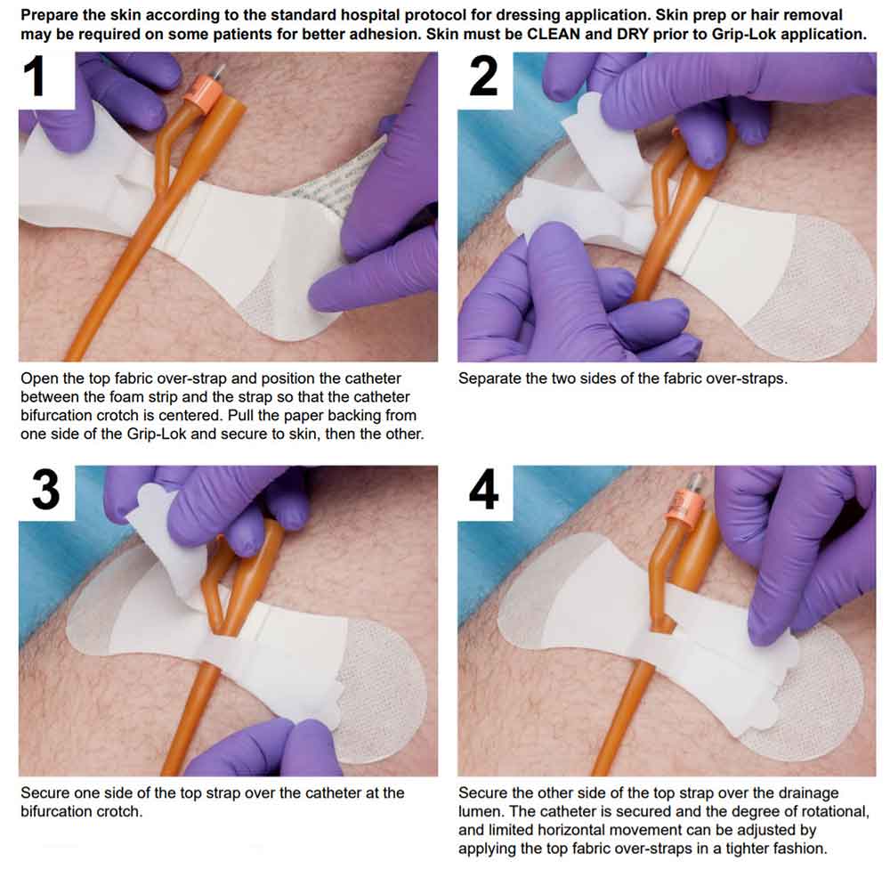 List 105+ Pictures How To Put A Catheter In A Woman Video Completed