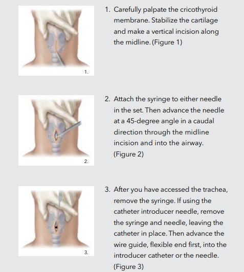 cricothyroid membrane incision