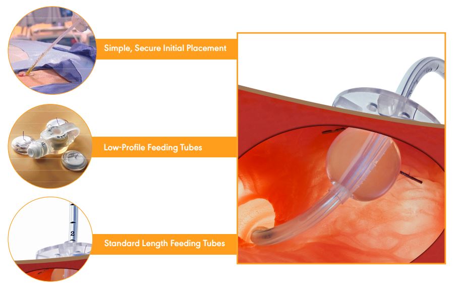 Avanos Introducer Kit For Gastrostomy Feeding Tube