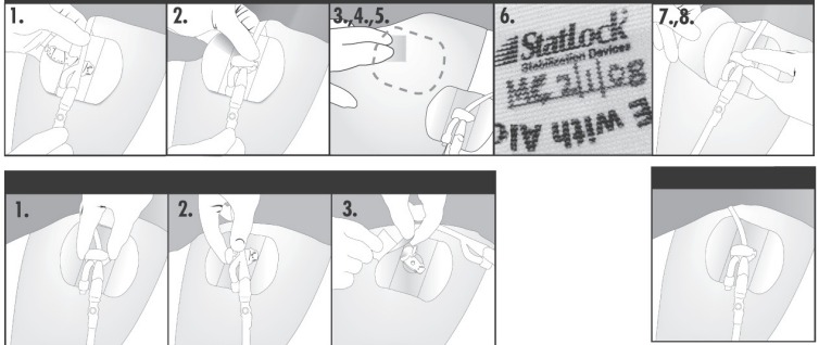 StatLock Foley Stabilization Device Application Technique