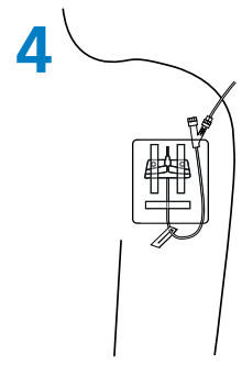 BD Saf-T-Intima closed IV catheter Insertion Guide