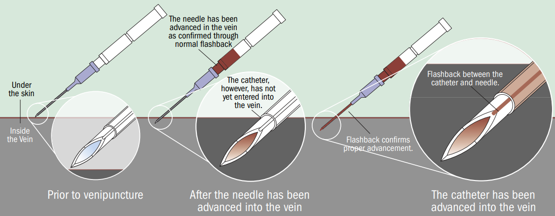 SurFlash Polyurethane I.V. Catheter Feature