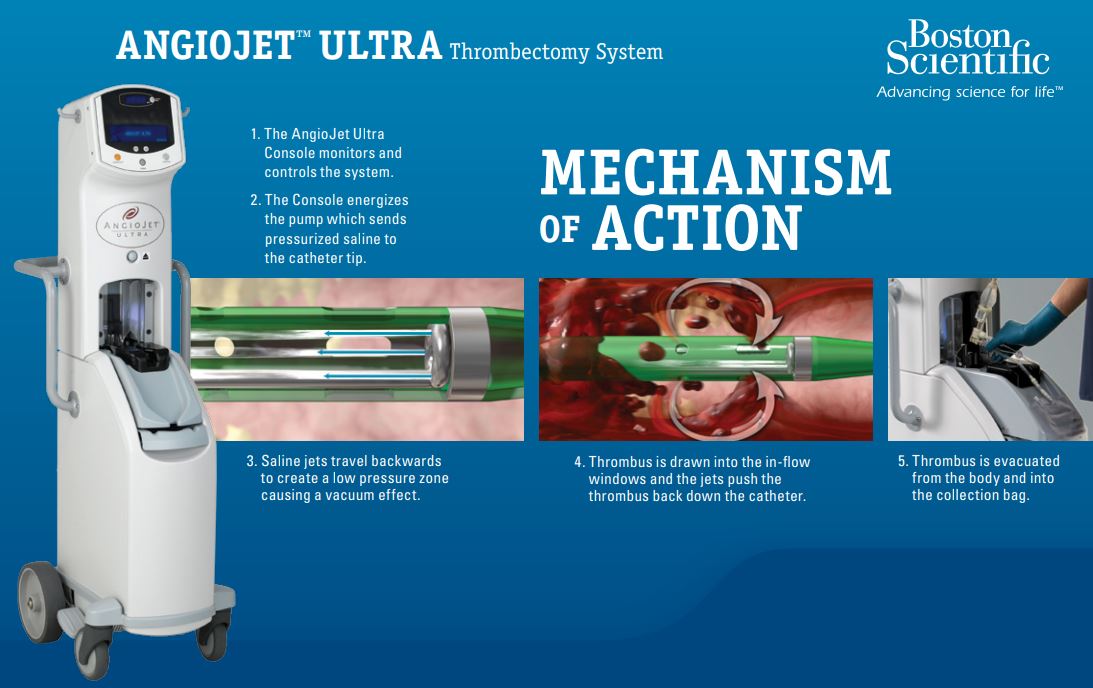 Boston Scientific AngioJet Peripheral Thrombectomy System