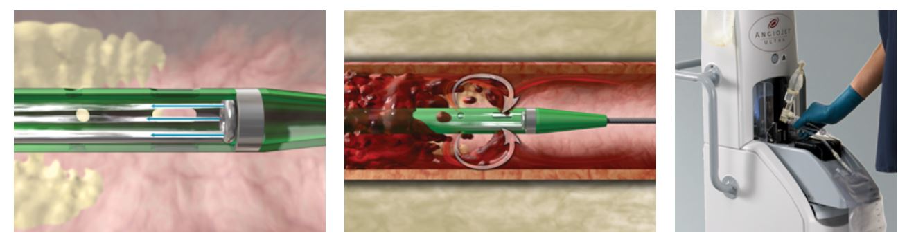 Boston Scientific 104834-0021 - Kit Thrombectomy Angiojet
