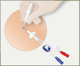 Adhezion Biomedical SP-015V50 - Secureportiv Catheter Securement ...