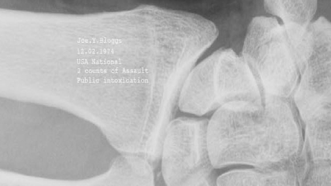 X-ray showing criminal record details