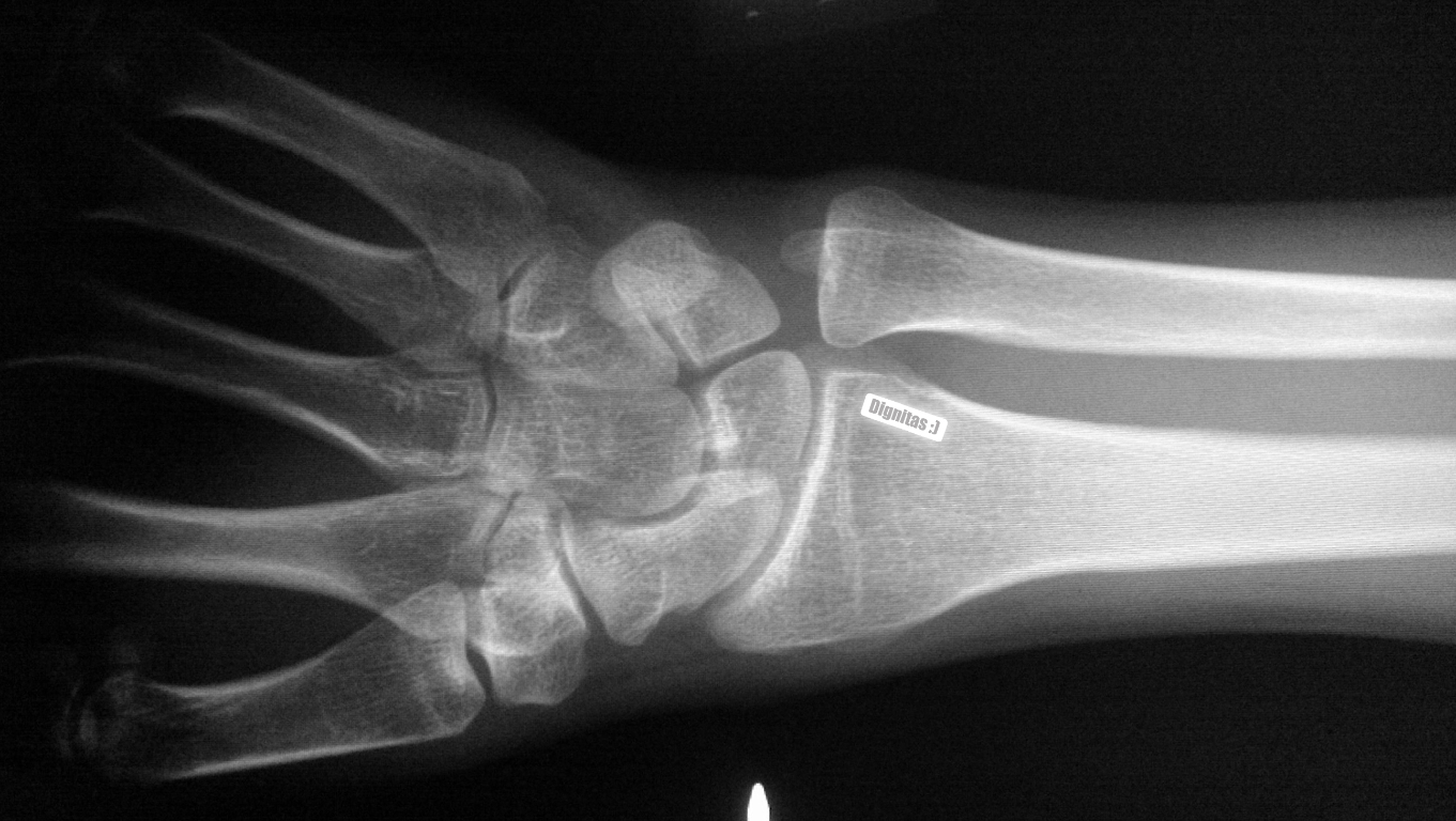 Wrist X-ray showing 'Dignitas :)' message