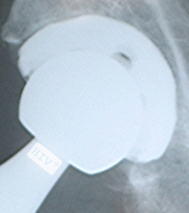 Hip X-ray showing ‘HIV+’ message (detail)