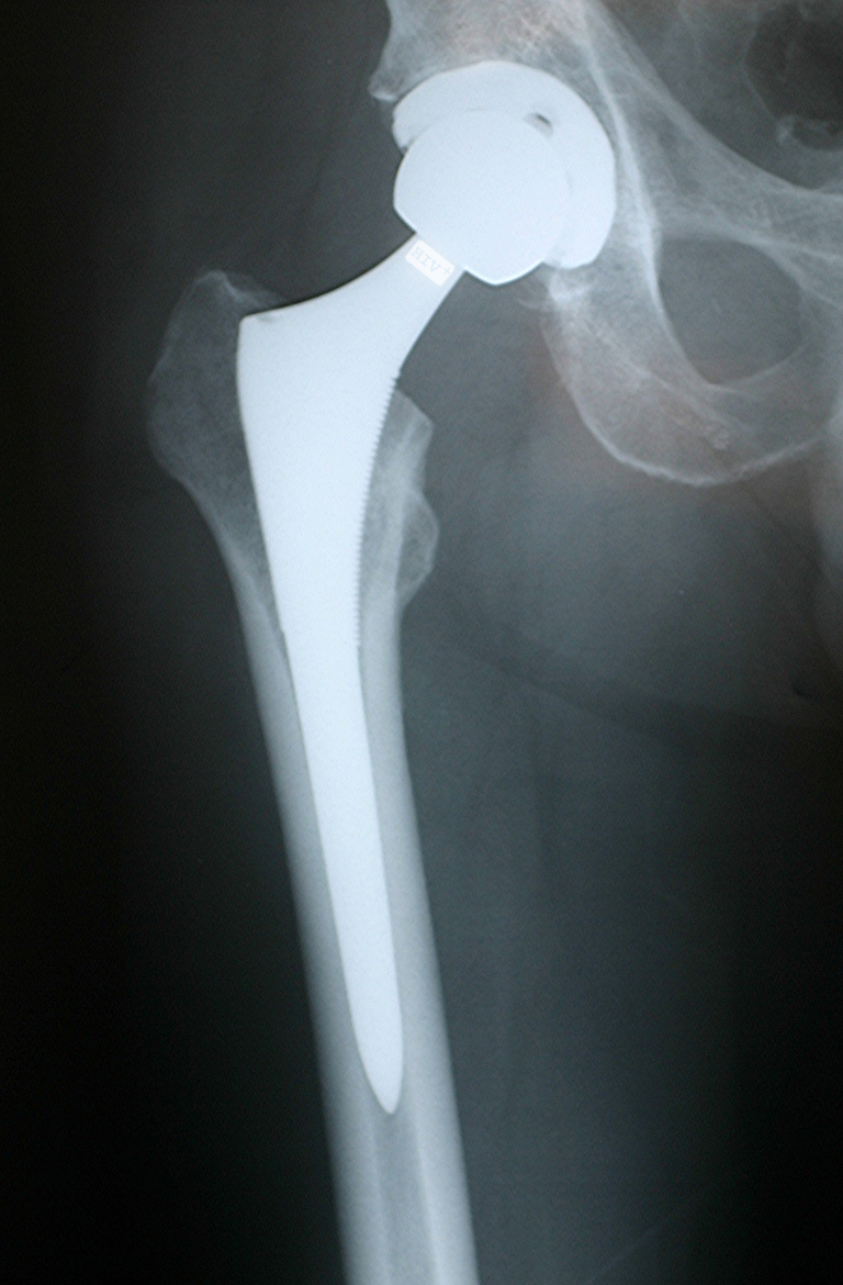 Hip X-ray showing 'HIV+' message
