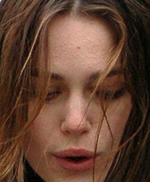 Keira Knightly Has Chronic Adult Acne Clear Skincare Clinics V tryoh chastyah piratah karibskogo morya sygrala elizabet suonn. keira knightly has chronic adult acne