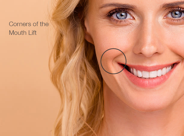 Corners-of-mouth-lift