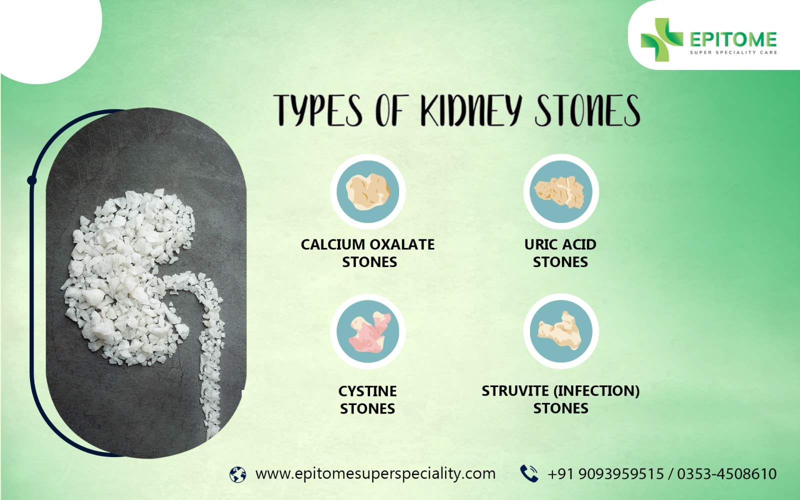 Not All Stones Are the Same: A Patient's Guide to Kidney Stone Types!