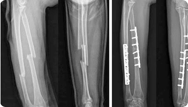 X-ray of a fractured bone with surgical implants