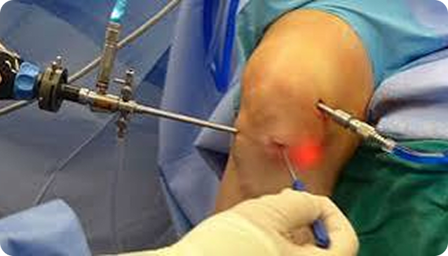 Arthroscopic monitor view of a joint