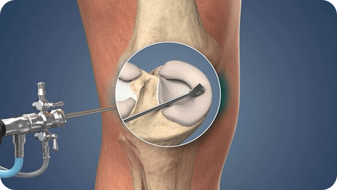 Arthroscopic surgical instrument in use
