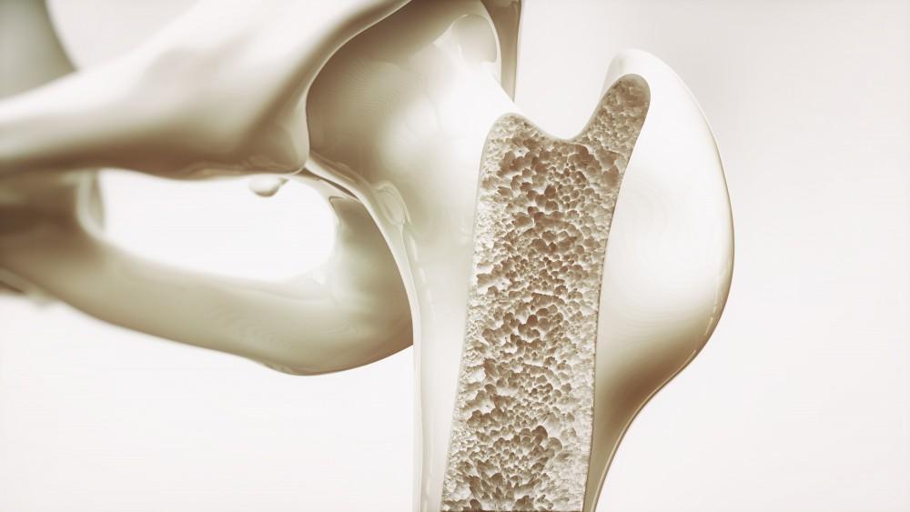 Osteoporosis and Bone Health Management