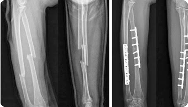 X-ray of a fractured bone with surgical implants