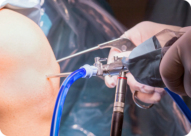 Arthroscopic knee surgery procedure