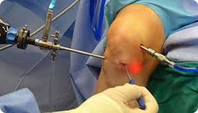 Arthroscopic monitor view of a joint