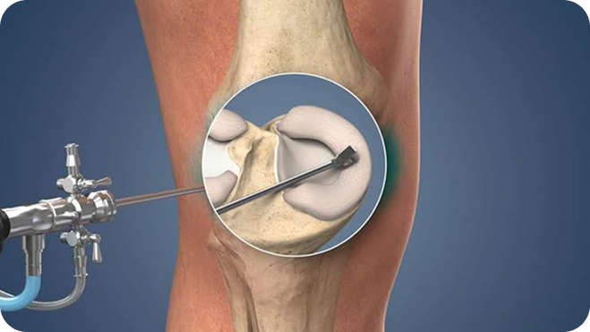 Arthroscopic surgical instrument in use