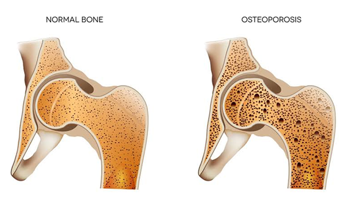 Illustration of joint replacement procedure