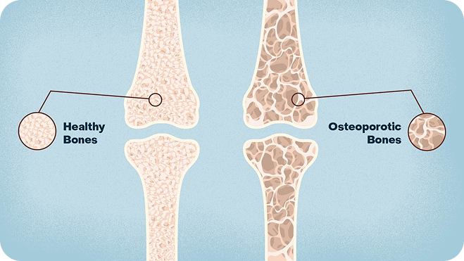 Comparison of normal bone and arthritic bone