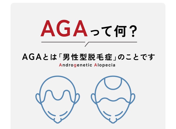 AGAとは「男性型脱毛症」のことです。