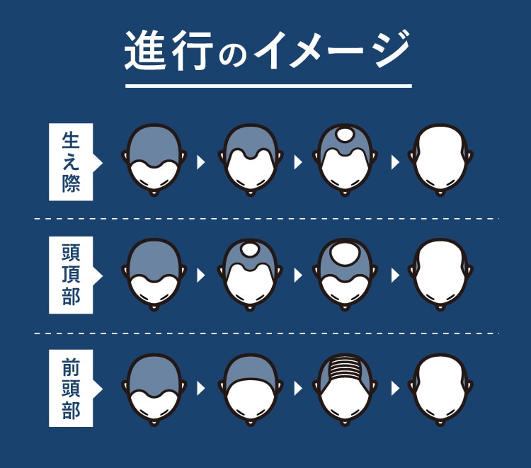 進行のイメージ 生え際 頭頂部 前頭部